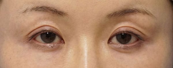 切らない眼瞼下垂　2週間後のBefore写真