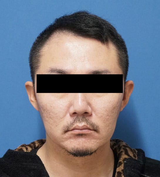 ミントリフトミニ10本(ホホ・フェイスライン・ホホ骨) 1ヶ月後のBefore写真