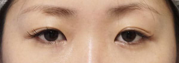 切らない眼瞼下垂プレミアム　1か月後のBefore写真