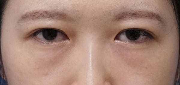 目の下の脂肪とり　手術直後、1ヶ月後のBefore写真