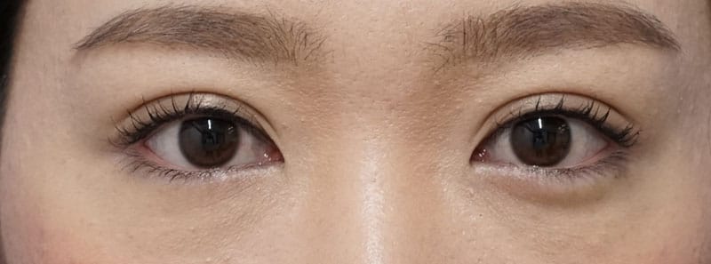 スマートバランス　1ヶ月後のAfterの写真