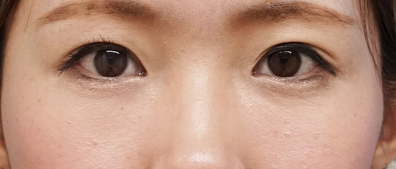 目の下脂肪取り+コンデンス脂肪注入 3ヶ月後のAfterの写真