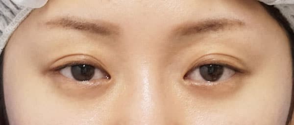 切らない眼瞼下垂プレミアム　3ヶ月後のBefore写真