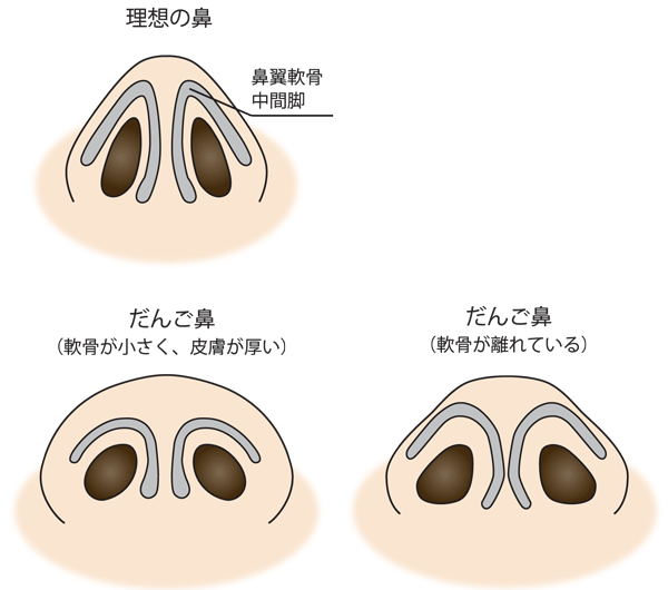 美人に見える理想の鼻とは 団子鼻や豚鼻 矢印鼻を治す整形方法 東京新宿の美容整形ならもとび美容外科クリニック