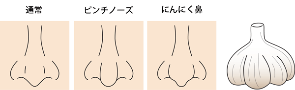 美人に見える理想の鼻とは 団子鼻や豚鼻 矢印鼻を治す整形方法 東京新宿の美容整形ならもとび美容外科クリニック