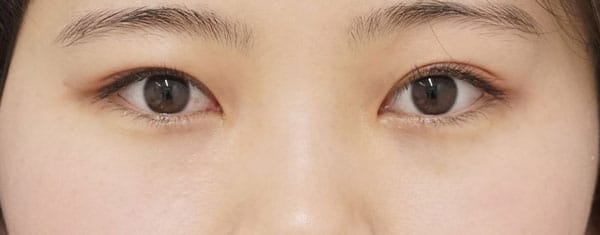 鼻尖縮小＋軟骨移植＋ストラット、鼻翼縮小（内＋外）　３ヶ月後　正面のBefore写真