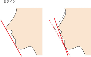 鼻Eライン 鼻整形