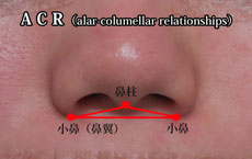 ACR 鼻整形
