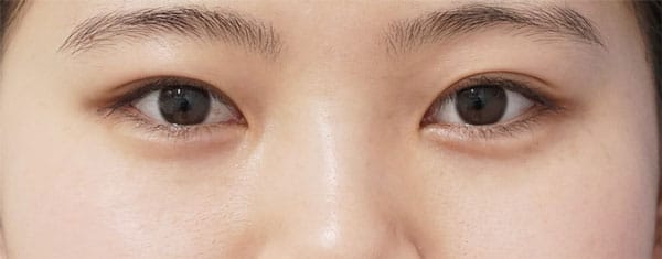 涙袋形成（ヒアルロン酸）　1週間後のAfter写真