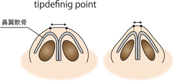 tip-defining-point団子鼻軟骨 鼻整形