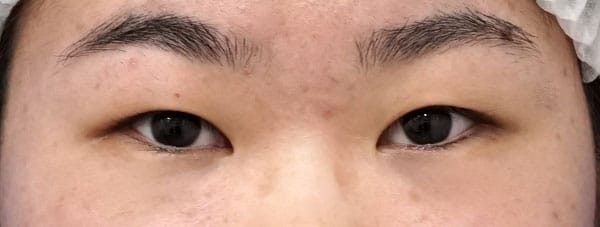 もとびアイゴールド＋厚みとり　手術直後　動画ものBefore写真