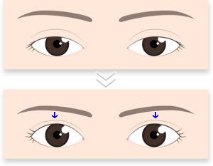 眼瞼下垂で眉が下がるイメージ