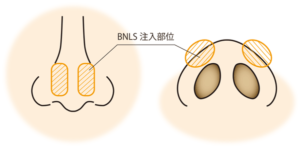 鼻BNLS注入部位