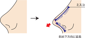 ミスコ（MISKO）延長の側面図