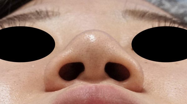 鼻尖縮小(3D法)、軟骨移植　１ヶ月後のBefore写真