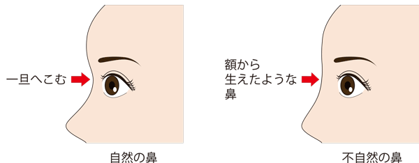 ゴツゴツしてる 平べったい おでこの形を丸くする方法 東京新宿の美容整形ならもとび美容外科クリニック