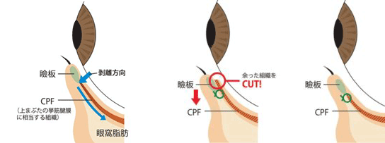 下眼瞼下制手術