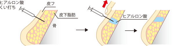 ヒアルロン酸杭打ちによるリフトアップ