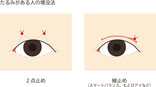 たるみがある人の点止めと線止めのイメージ