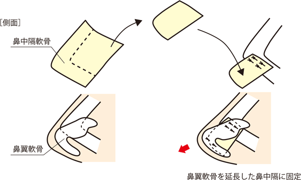 鼻中隔延長の軟骨移植