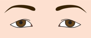 たるみがある瞼