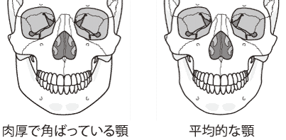 下あご骨　エラの悩み