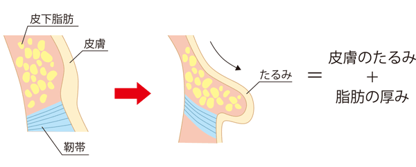 たるみは皮膚のたるみと脂肪の厚みが原因