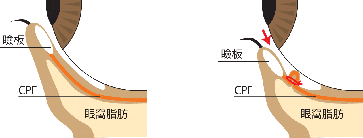 切らないタレ目術の断面図