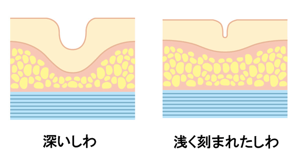 深いしわ、浅く刻まれたしわ