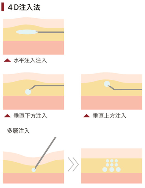 4D注入法　脂肪注入　ゴルゴ線