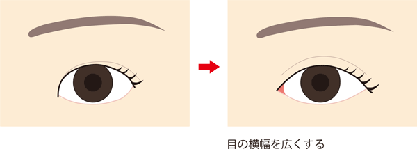 横幅 広げる の 目 を 目の幅が狭くてお悩みの方へ 目の横幅を広くする方法｜東京新宿の美容整形ならもとび美容外科クリニック