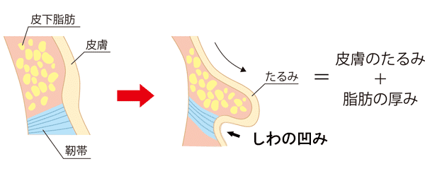 たるみは皮膚のたるみと脂肪