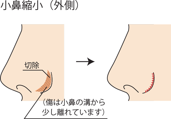 小鼻縮小外側切除方法