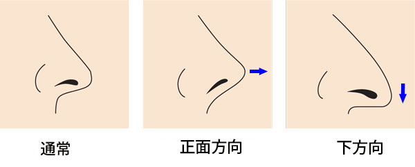 鼻の側面高くする方法