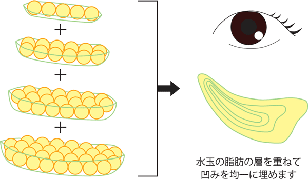 脂肪注入そ少しずつ重ねて注入してボリュームを出す図