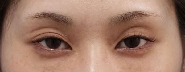 切らない眼瞼下垂プレミアム　1ヶ月後のBefore写真