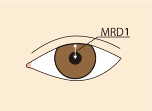 眼瞼下垂MRD-1