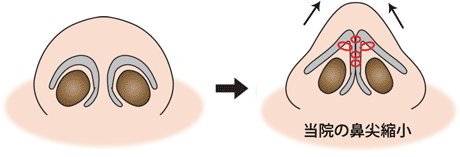 鼻翼軟骨の鼻尖縮小の変化