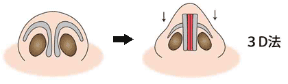 鼻尖縮小３D法の鼻翼軟骨の変化