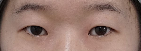 スマートバランス三か月後のBefore写真