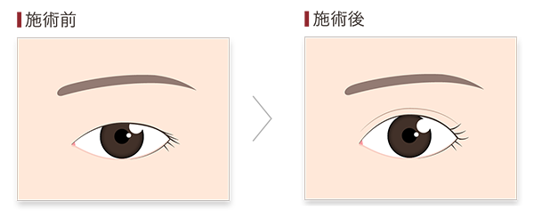 二重術で一重を二重にするイメージ