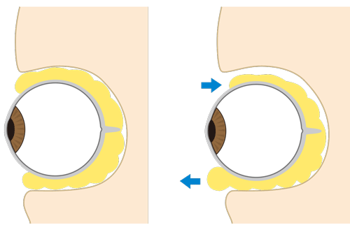 眼窩脂肪の加齢変化