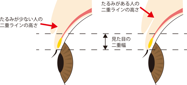 たるみがある人とない人の二重の高さの違い