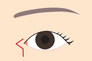 目頭切開Z形成の傷跡