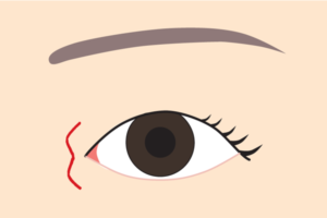 目頭切開W形成の傷跡
