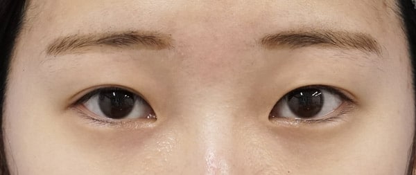 目頭切開（Z形成）、眉下切開　1ヶ月後のBefore写真