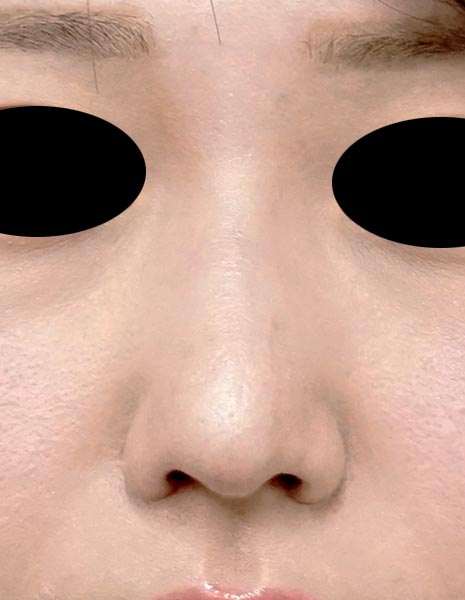 鼻尖縮小、軟骨移植、鼻翼縮小(内側+外側) 1ヶ月後のAfterの写真