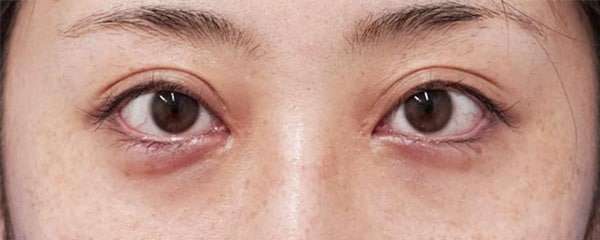 目頭切開(Z形成)、切らないタレ目 3ヶ月後のAfterの写真