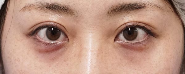 目頭切開(Z形成)、切らないタレ目 3ヶ月後のBefore写真