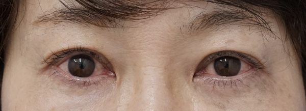 切らない眼瞼下垂 術前⇒一週間後のAfterの写真